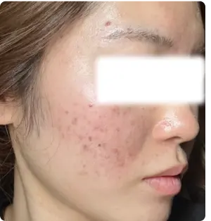 ニキビ・赤み・毛穴の開き