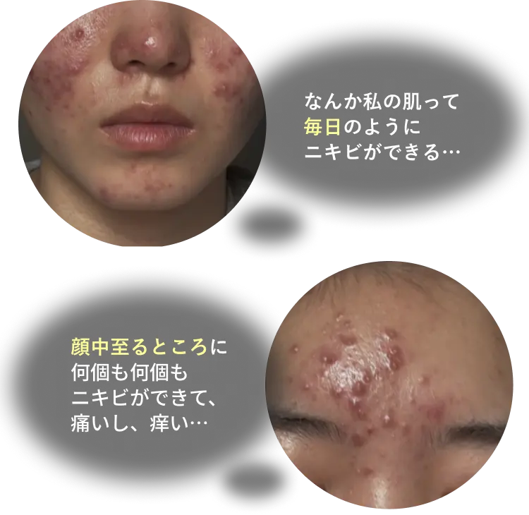 顔中のニキビ