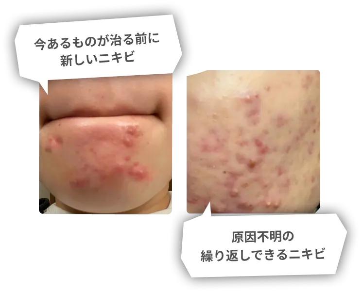 今あるものが治る前に新しいニキビ。原因不明の繰り返しできるニキビ